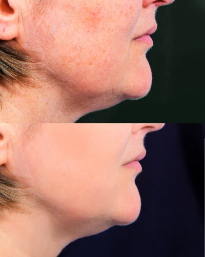 antes y despues manchas en es rostro peeling facial