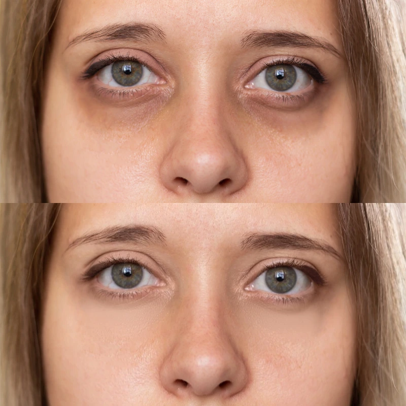 despigmentacion-barranquilla-blanqueamiento-facial-doctora-luisa-obregon-ojeras