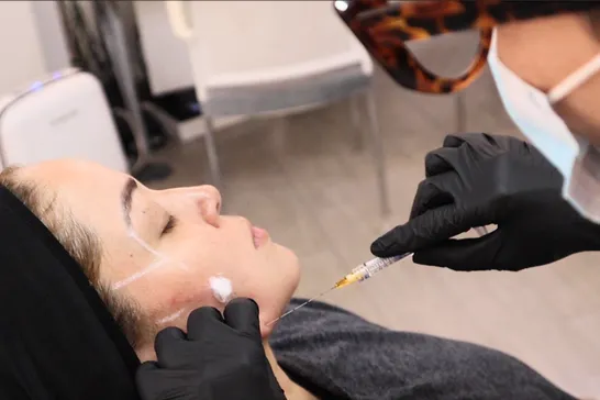 Armonización facial con Ácido Hialurónico