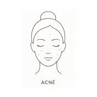 Acné