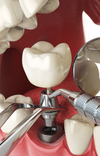 implante-dental-dr-mauricio