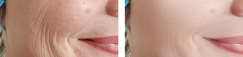 piel con colageno y con perdida de colageno