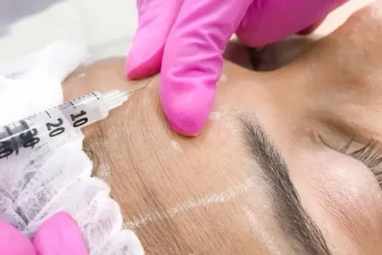 Aplicación experta de Toxina Botulínica